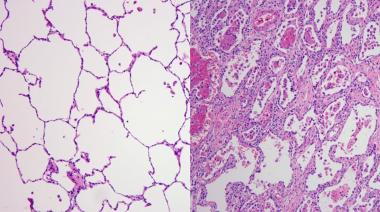 Científicos argentinos identifican 70 genes de células pulmonares que se verían afectados durante la infección por COVID-19