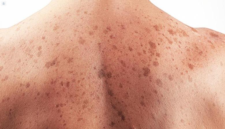 Los detalles de la primera vacuna argentina contra el cáncer de piel más agresivo y cuándo estará disponible en el país